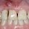 Bone Loss around Teeth