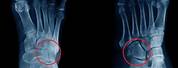 Broken Cuboid Bone in Foot