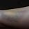 Bruised Arm