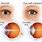 Cataract Eye Chart