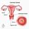 Cervical Cancer Pictures Images