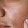 Contact Dermatitis On Face