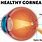 Cornea of Eye