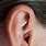 Ear Warts in Humans