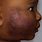 Eczema On Face Dark Skin