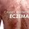 Eczema Symptoms and Treatment