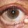 Eye Cysts Types
