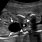 Fetal Ovarian Cyst Ultrasound