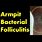 Folliculitis Under Armpit