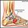 Foot Pain Cuboid Bone