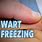 Frozen Wart