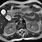 Gallbladder MRI