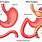 Gastric Bypass Anatomy