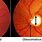 Glaucoma Optic Nerve