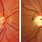 Glaucoma Retina
