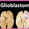 Glioblastoma Patients