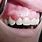 Gum Lesions