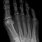 Hairline Fracture Foot