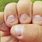 Hand Finger Nail Fungus
