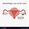 Hemorrhagic Cyst On Ovary