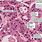 Hepatocellular Carcinoma Histology