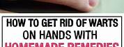 How to Get Rid of Warts On Your Hands