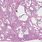 Interstitial Lung Disease Histology