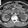 Lithium Nephropathy