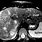 Liver Cirrhosis MRI
