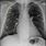 Lung Nodule CXR