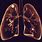 Lung Nodules Concern