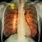 Malignant Lung Tumor