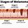 Metastatic Melanoma Stages