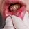 Oral Cancer On Lip