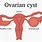 Ovarian Cyst Diagram