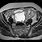 Ovarian Mass MRI