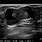 Papilloma Ultrasound