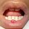 Pedunculated Tongue Lesion