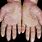 Psoriasis On Palms of Hands