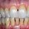 Receding Gum Disease