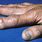 Rheumatoid Arthritis Nodules