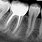 Root Canal Tooth X-ray