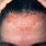 Scabies On Scalp