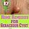 Sebaceous Cyst Home Remedies