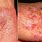 Severe Skin Diseases