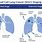 Small Cell Lung Cancer Stages