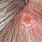 Squamous Cell Carcinoma On Head