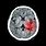 Stroke CT Brain Scan