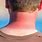 SunBurn Skin Cancer
