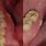 Tooth Bone Spur